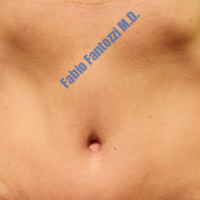 Abdominoplasty case 7 (reconstruction of umbilical region) – After