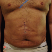 Abdominoplasty after incisional hernia – After