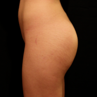 Gluteal Augmentation with HA, case 5 – After