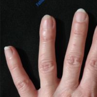 Reconstruction of finger – Case 11 – After