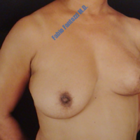 Repair of breasts after breast cancer (case 3) – Before